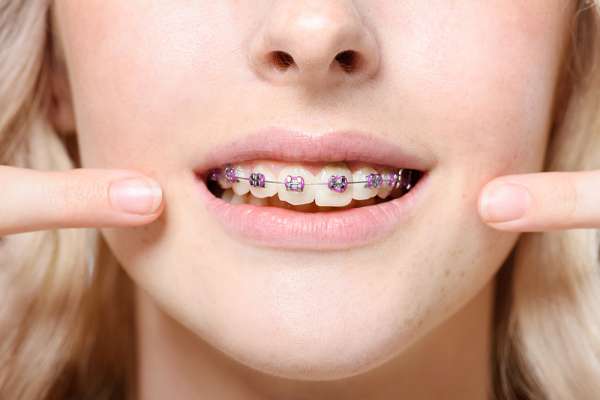 Braces | Greenlife Dental