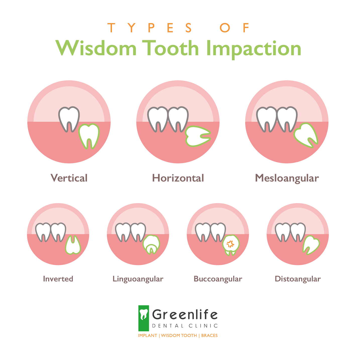 impacted wisdom tooth horizontal