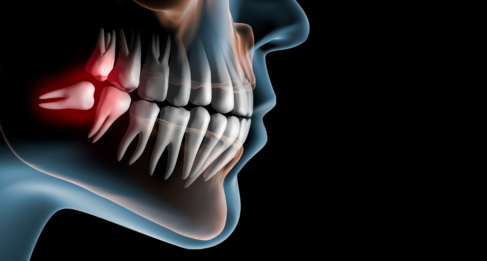 Стоматолог зуб мудрости