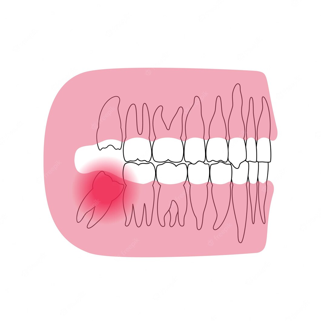 i-want-to-extract-my-wisdom-tooth-what-should-i-do-before-during-and