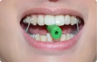 How to comfortably wear your invisalign aligners to parties 2