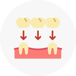 Dental Bridge
